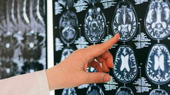 AI brain scan tool predicts how fast you are aging
