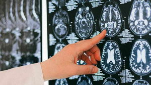 AI brain scan tool predicts how fast you are aging