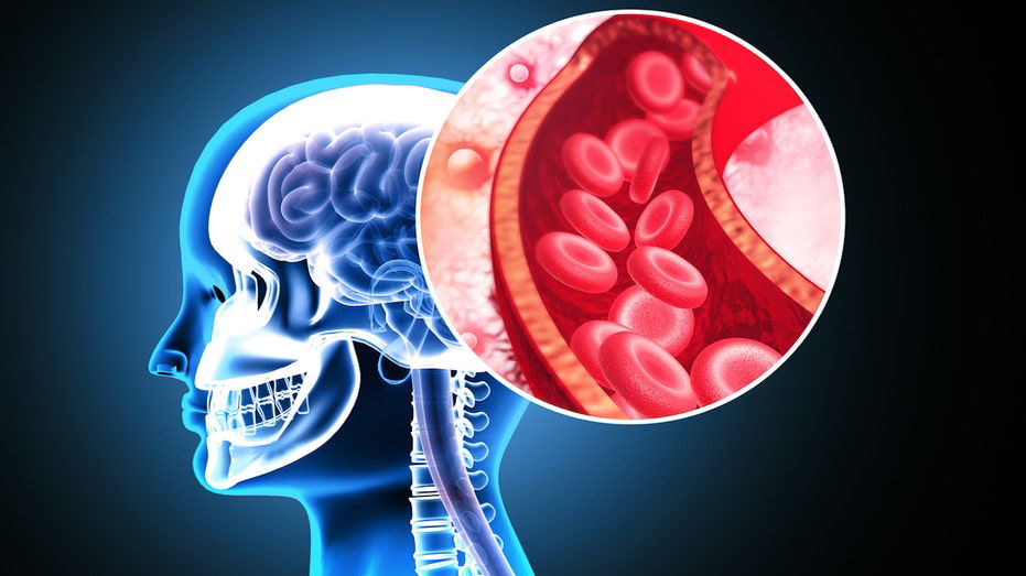 Stanford researchers develop 'game-changing' stroke treatment that doubles effectiveness